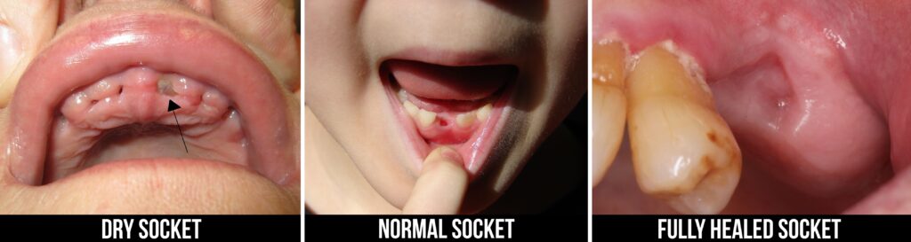 dry socket vs normal socket vs healed socket