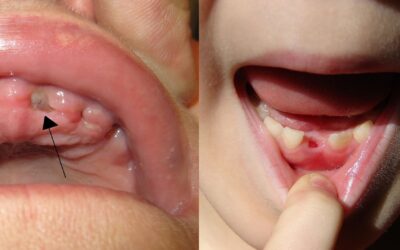 Signs of a Normal Socket After Tooth Extraction