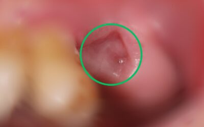 Recovery Tips for a Normal Socket After Tooth Extraction
