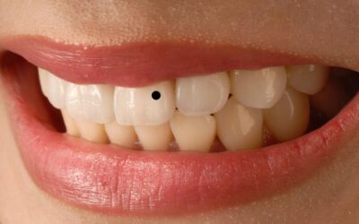 Black Dot on Tooth: Causes, Signs & Treatment Tips