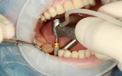 Single Tooth Implant Cost Without Insurance: Full Guide