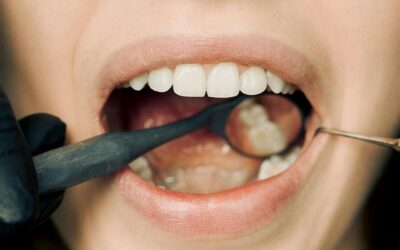 Healing Normal Socket After Tooth Extraction (Timeline)