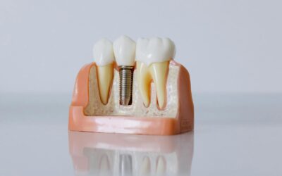 How Much Is a Tooth Implant? Full Cost Breakdown