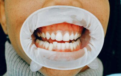 White Gums Around Teeth: Causes, Remedies & When to Worry