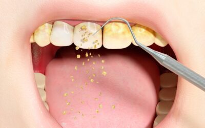 Remove Tartar from Teeth Naturally with Simple Remedies