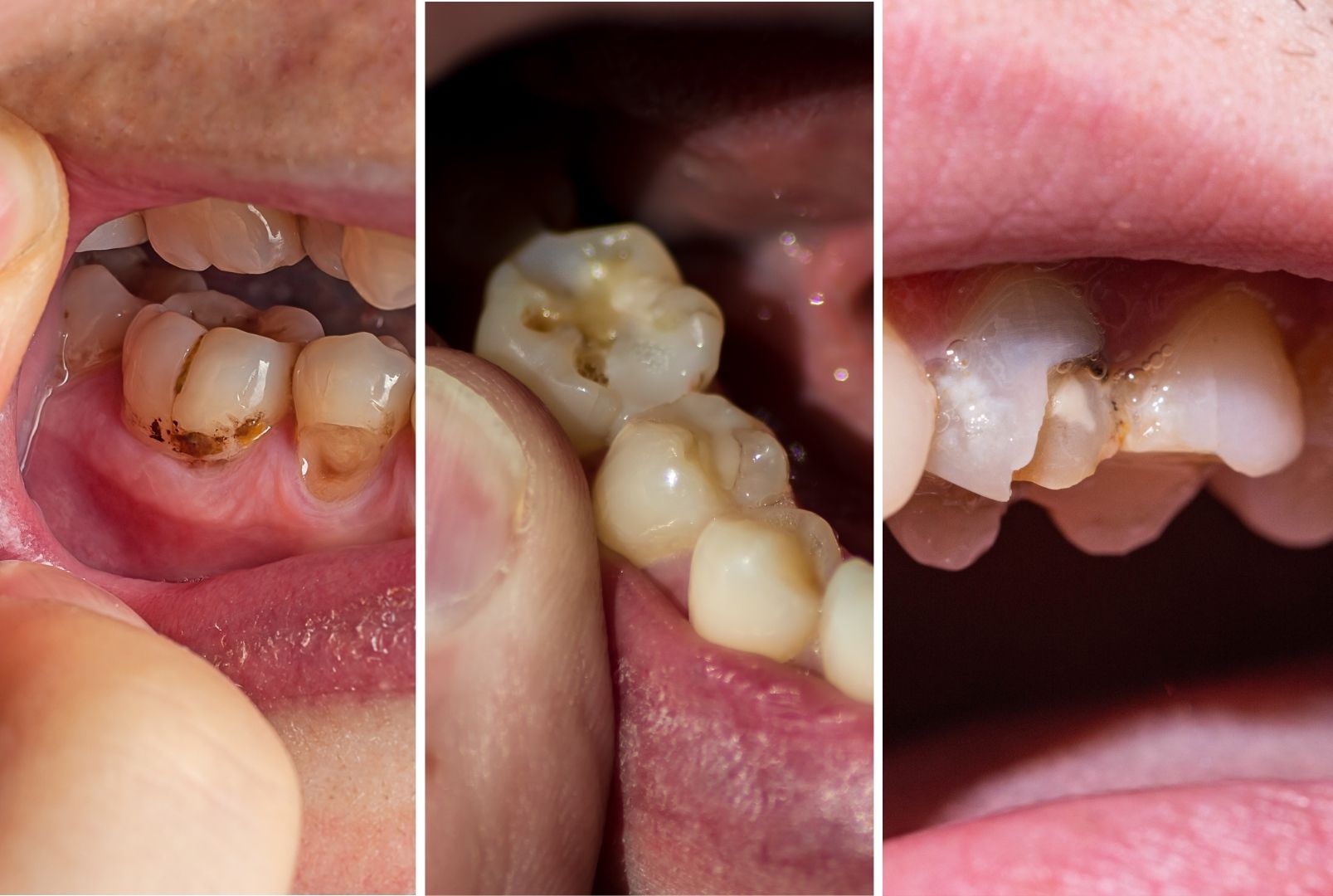 Cavity on Front Tooth