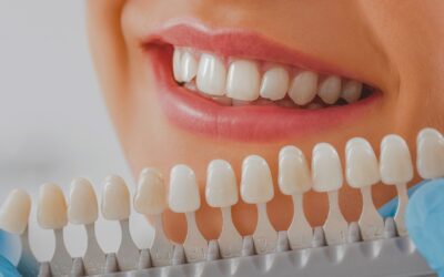 Front Tooth Crown Cost: Price Breakdown & What to Know