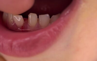 How to Tighten a Loose Tooth at Home: 9 Proven Remedies