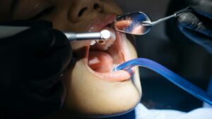 How Do You Know If You Need a Root Canal
